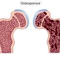 Como se prevenir da osteoporose?