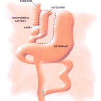 Cirurgia Bariátrica / Cirurgia da Obesidade (Gastroplastia) Cirurgia Bariátrica / Cirurgia da Obesidade (Gastroplastia)