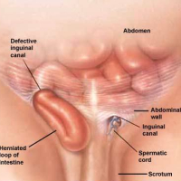 Cirurgia para Hérnia na Virilha