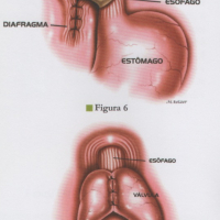 Cirurgia do Refluxo / Hérnia de Hiato Cirurgia do Refluxo / Hérnia de Hiato