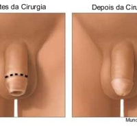 Postectomia (tratamento da Fimose) Postectomia (tratamento da Fimose)
