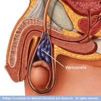 Varicocele Varicocele