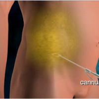 Lipoaspiração Lipoaspiração